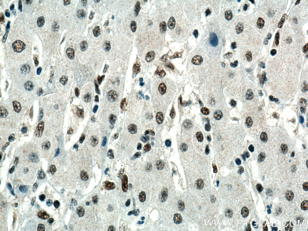 Immunohistochemistry (IHC) staining of human liver cancer tissue using KDM1 Monoclonal antibody (67037-1-Ig)
