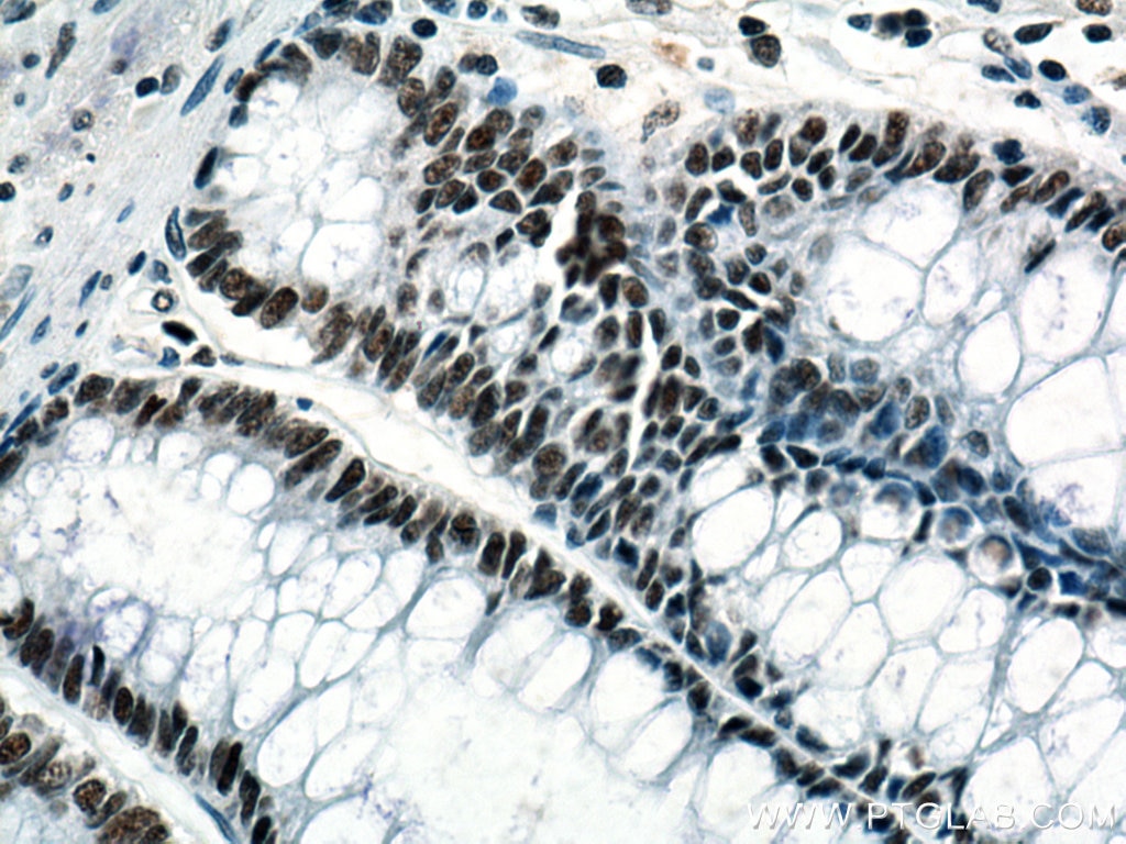 Immunohistochemistry (IHC) staining of human colon cancer tissue using KDM1 Monoclonal antibody (67037-1-Ig)