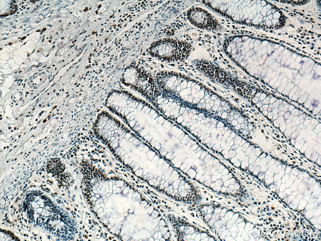 Immunohistochemistry (IHC) staining of human colon cancer tissue using KDM1 Monoclonal antibody (67037-1-Ig)