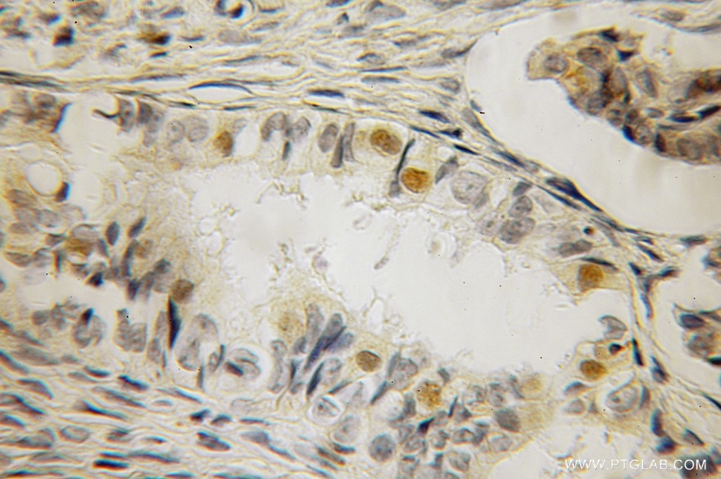 Immunohistochemistry (IHC) staining of human ovary tumor tissue using KDM3A,JMJD1A Polyclonal antibody (12835-1-AP)