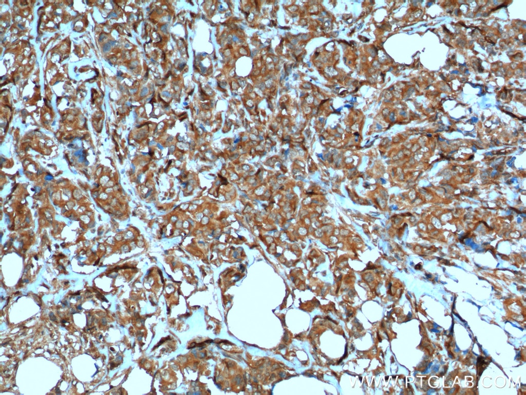 Immunohistochemistry (IHC) staining of human breast cancer tissue using VEGF Receptor 2 Polyclonal antibody (18975-1-AP)