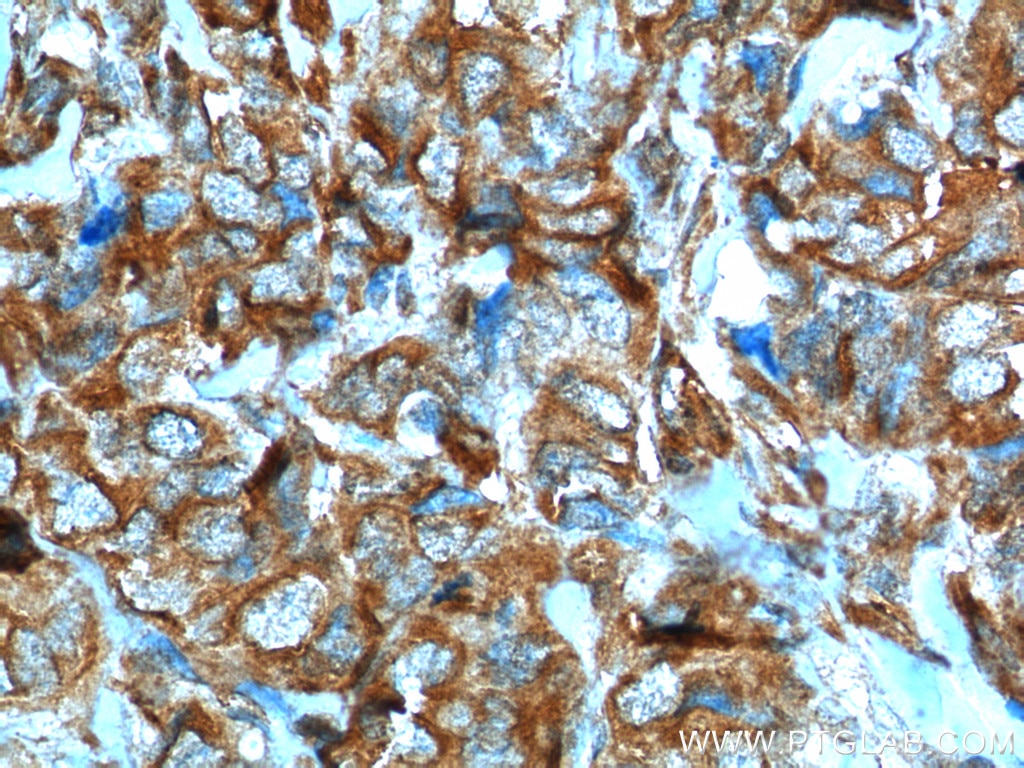 IHC staining of human breast cancer using 18975-1-AP