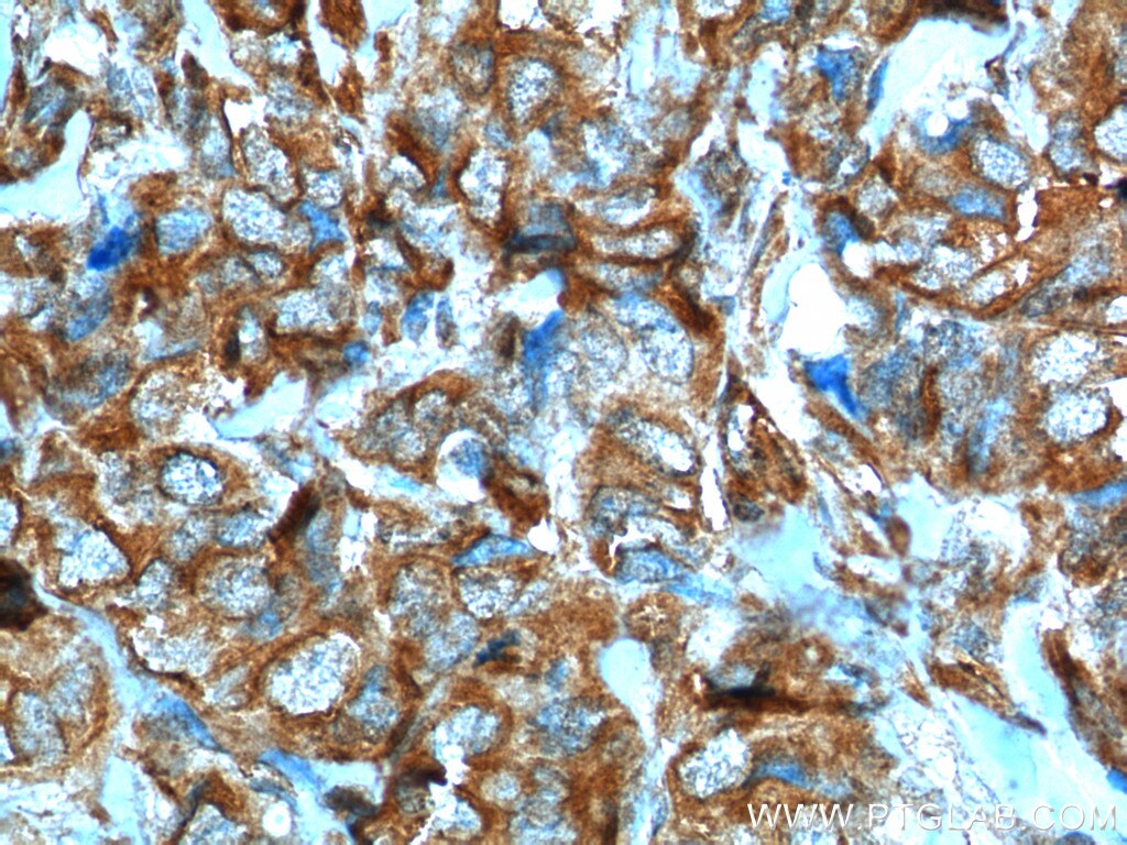 Immunohistochemistry (IHC) staining of human breast cancer tissue using VEGF Receptor 2 Polyclonal antibody (18975-1-AP)