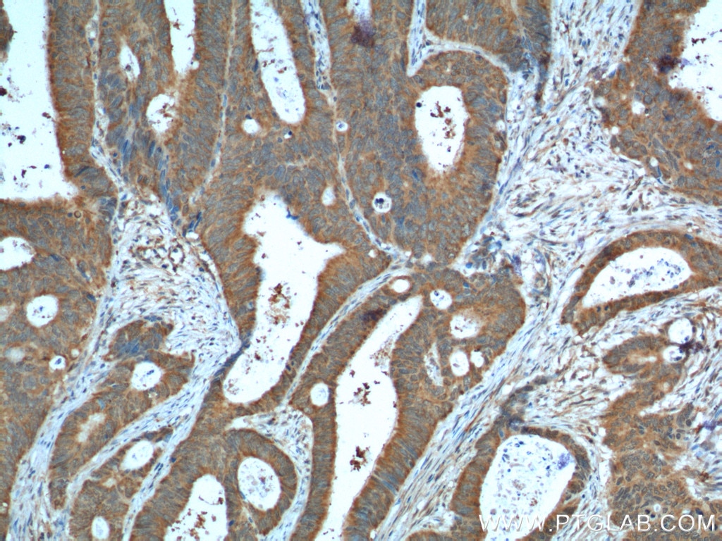 Immunohistochemistry (IHC) staining of human colon cancer tissue using VEGF Receptor 2 Polyclonal antibody (18975-1-AP)