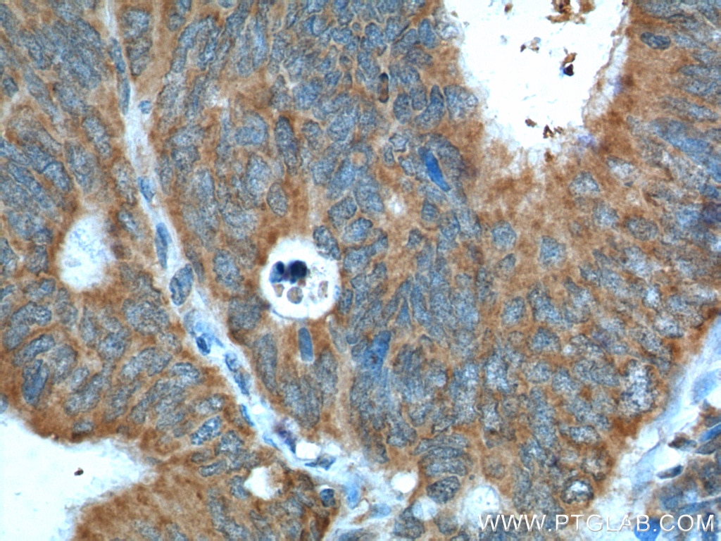 Immunohistochemistry (IHC) staining of human colon cancer tissue using VEGF Receptor 2 Polyclonal antibody (18975-1-AP)
