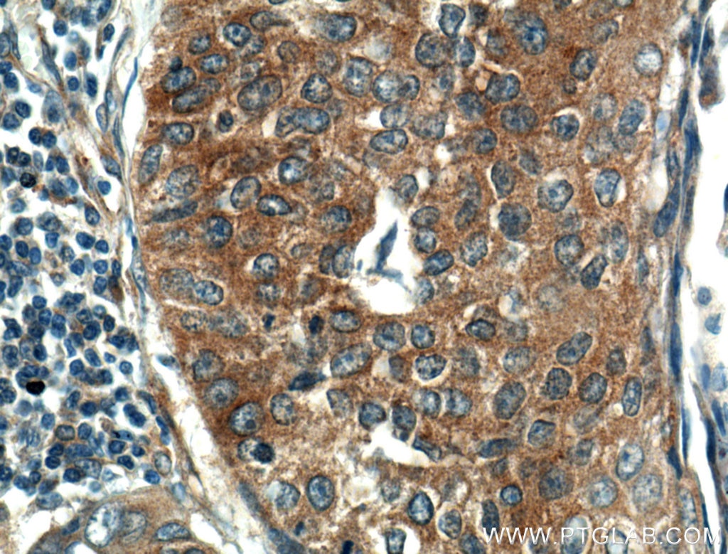 Immunohistochemistry (IHC) staining of human lung cancer tissue using KEAP1 Polyclonal antibody (10503-2-AP)