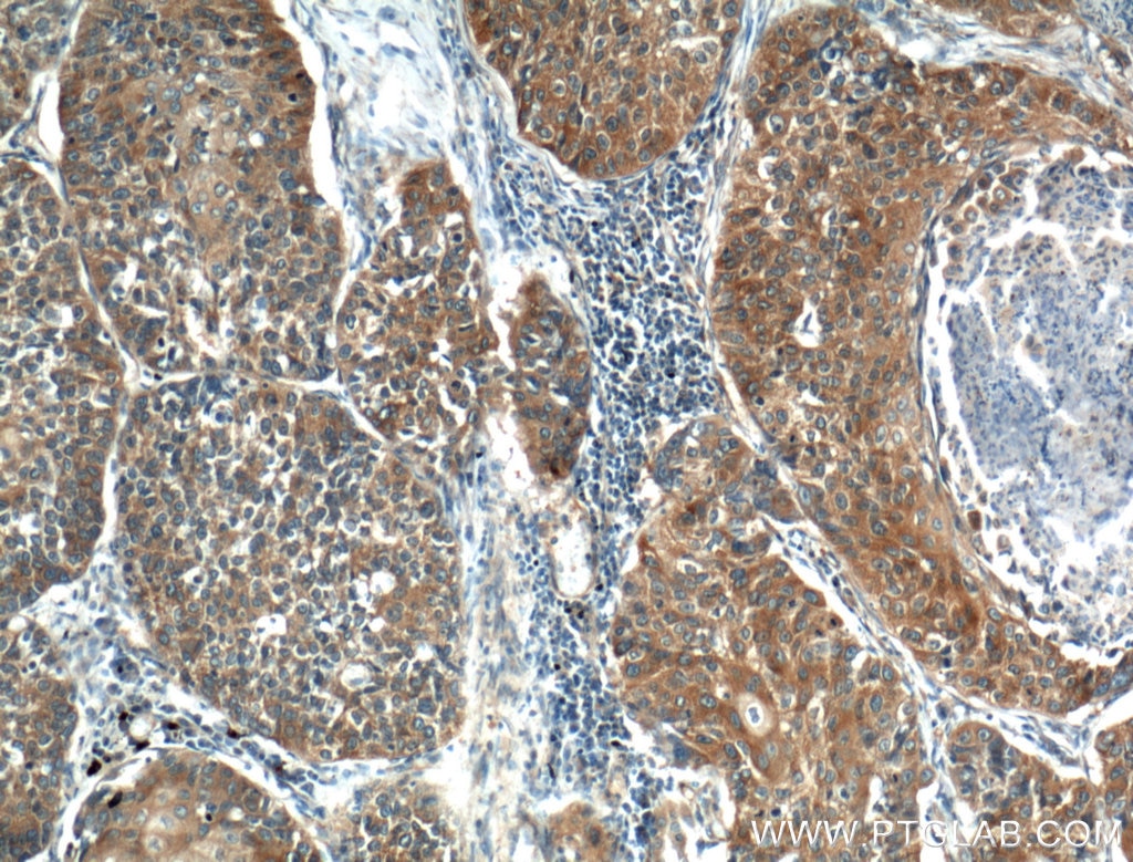 Immunohistochemistry (IHC) staining of human lung cancer tissue using KEAP1 Polyclonal antibody (10503-2-AP)