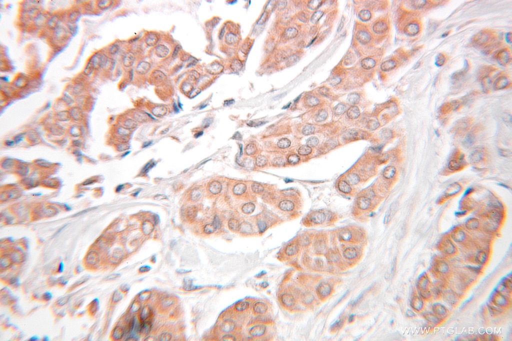 Immunohistochemistry (IHC) staining of human breast cancer tissue using KEAP1 Polyclonal antibody (10503-2-AP)