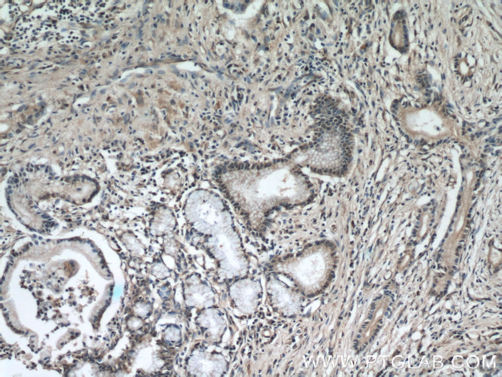 Immunohistochemistry (IHC) staining of human pancreas cancer tissue using KEAP1 Monoclonal antibody (60027-1-Ig)