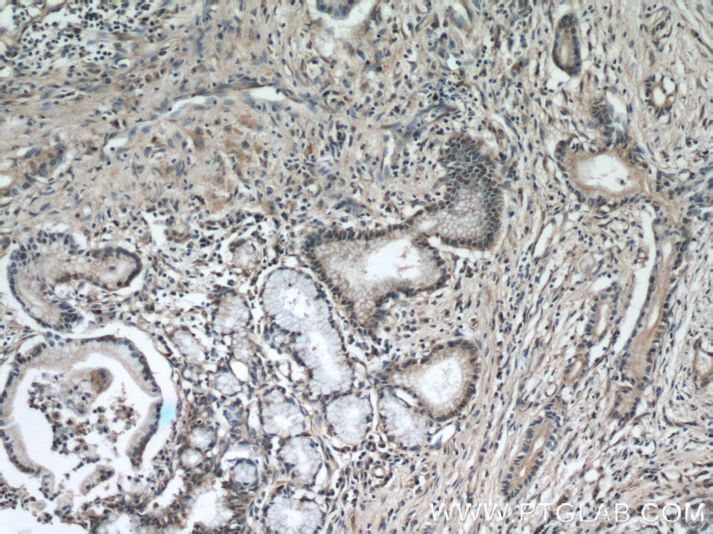 IHC staining of human pancreas cancer using 60027-1-Ig