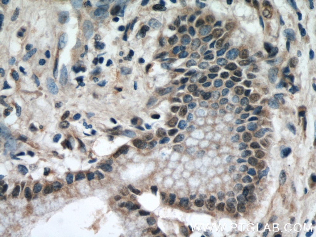 IHC staining of human pancreas cancer using 60027-1-Ig