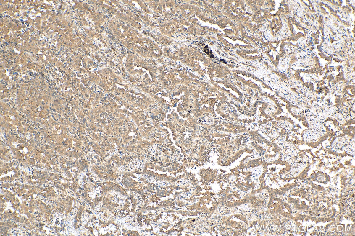 IHC staining of human lung cancer using 80744-1-RR