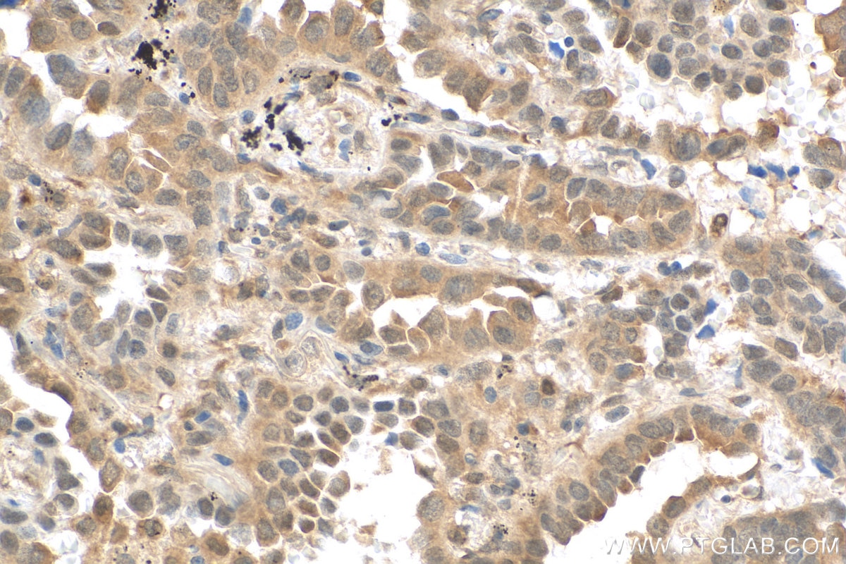 Immunohistochemistry (IHC) staining of human lung cancer tissue using KEAP1 Recombinant antibody (80744-1-RR)