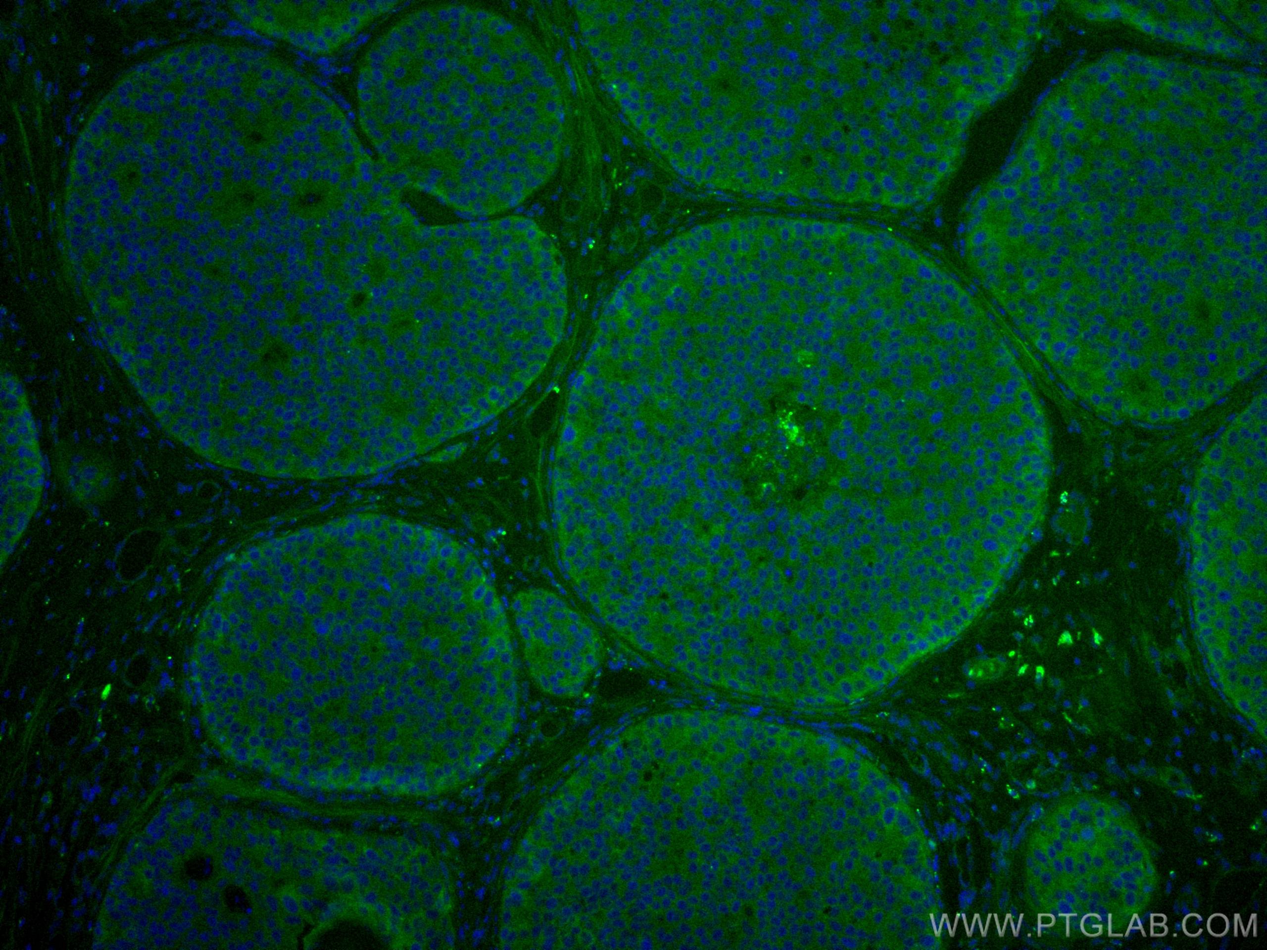 Immunofluorescence (IF) / fluorescent staining of human breast cancer tissue using CoraLite® Plus 488-conjugated KEAP1 Polyclonal ant (CL488-10503)