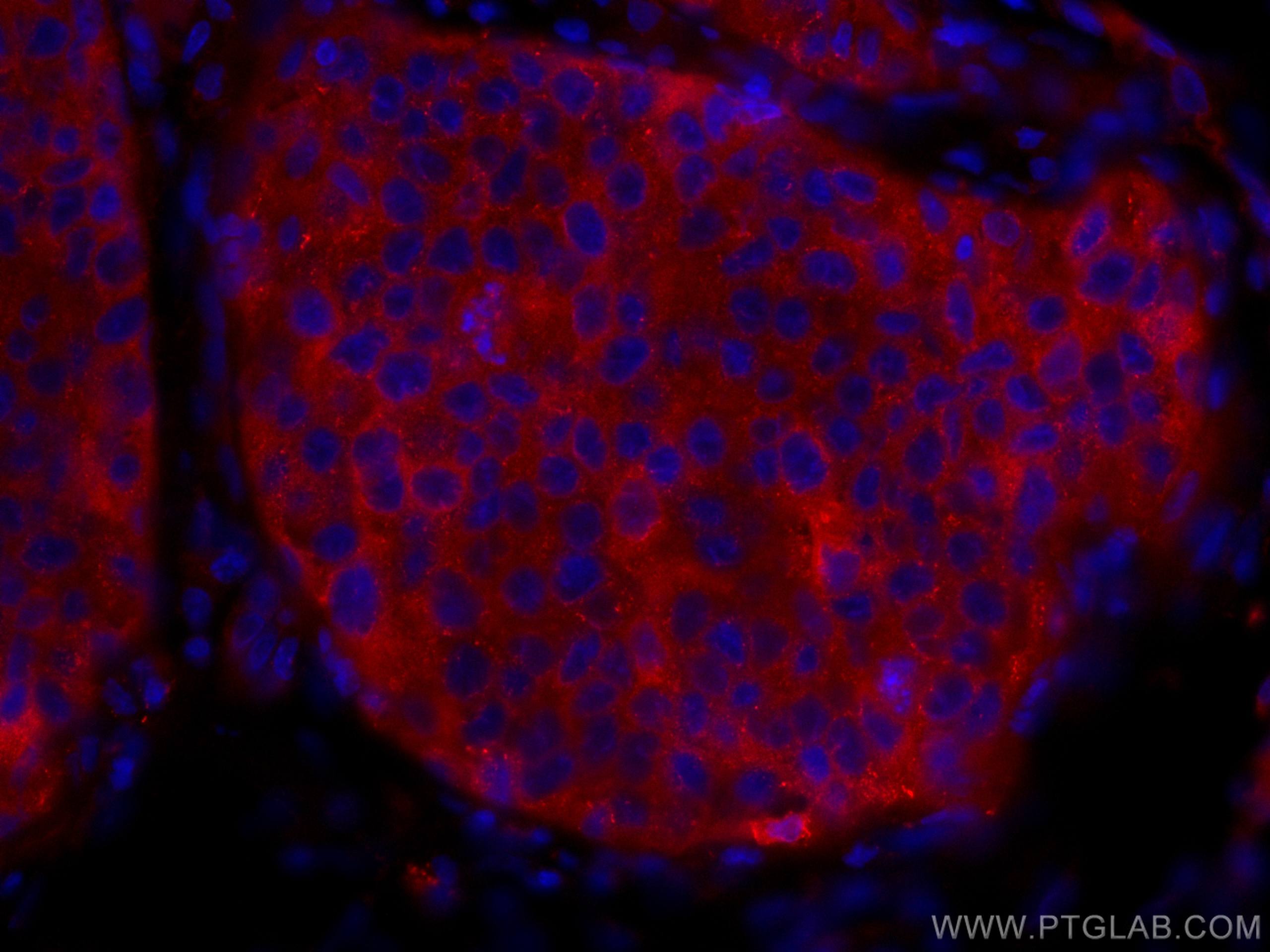 Immunofluorescence (IF) / fluorescent staining of human breast cancer tissue using CoraLite®594-conjugated KEAP1 Polyclonal antibody (CL594-10503)