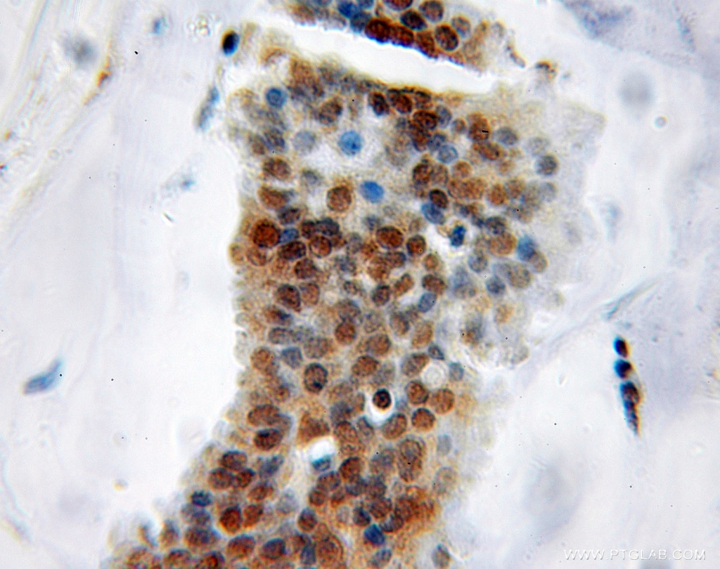 Immunohistochemistry (IHC) staining of human breast cancer tissue using Sam68 Polyclonal antibody (10222-1-AP)