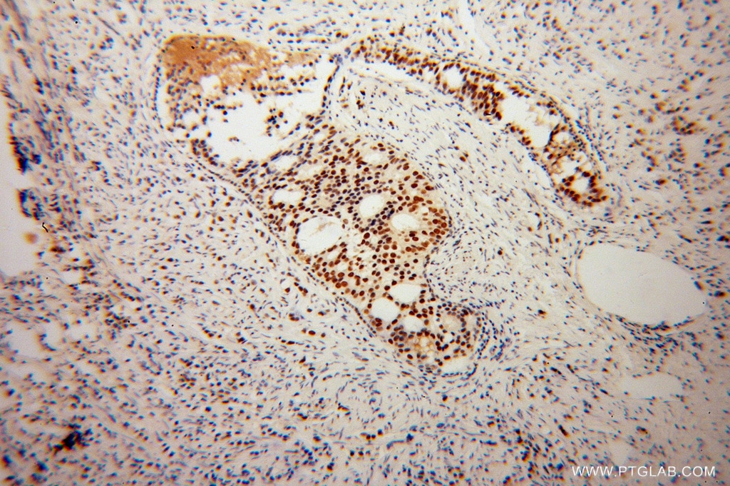 Immunohistochemistry (IHC) staining of human gliomas tissue using KHDRBS3 Polyclonal antibody (13563-1-AP)