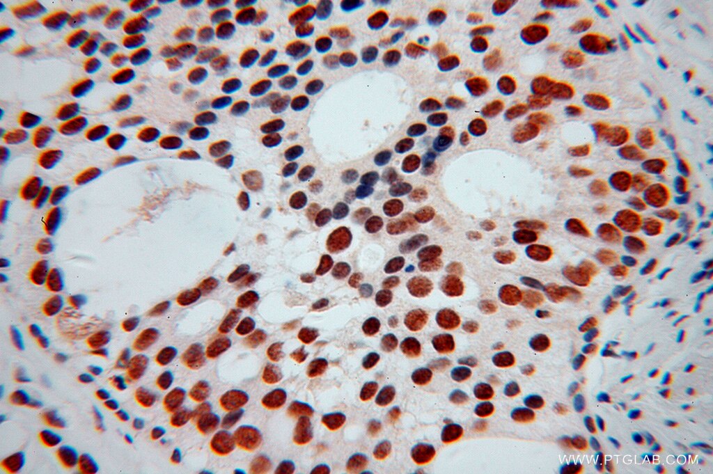 Immunohistochemistry (IHC) staining of human gliomas tissue using KHDRBS3 Polyclonal antibody (13563-1-AP)