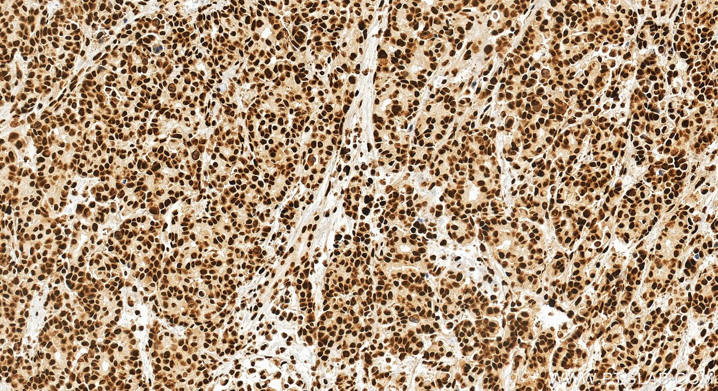 Immunohistochemical analysis of paraffin-embedded human stomach cancer tissue slide using 82931-1-RR (KHSRP antibody) at dilution of 1:400 (under 20x lens). Heat mediated antigen retrieval with Tris-EDTA buffer (pH 9.0). This data was developed using the same antibody clone with 82931-1-PBS in a different storage buffer formulation. Immunohistochemistry (IHC) staining of human stomach cancer tissue using KHSRP Recombinant monoclonal antibody (82931-1-RR)