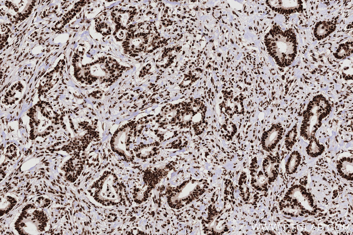 Immunohistochemistry (IHC) staining of human rectal cancer tissue using KHSRP Recombinant monoclonal antibody (82931-5-RR)