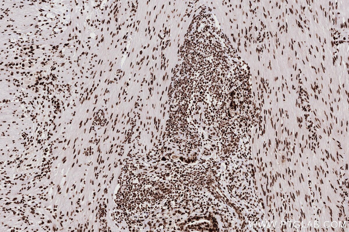 Immunohistochemistry (IHC) staining of human rectal cancer tissue using KHSRP Recombinant monoclonal antibody (82931-5-RR)