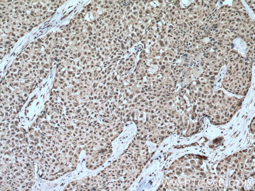 Immunohistochemistry (IHC) staining of human lung cancer tissue using KI67 Polyclonal antibody (27309-1-AP)