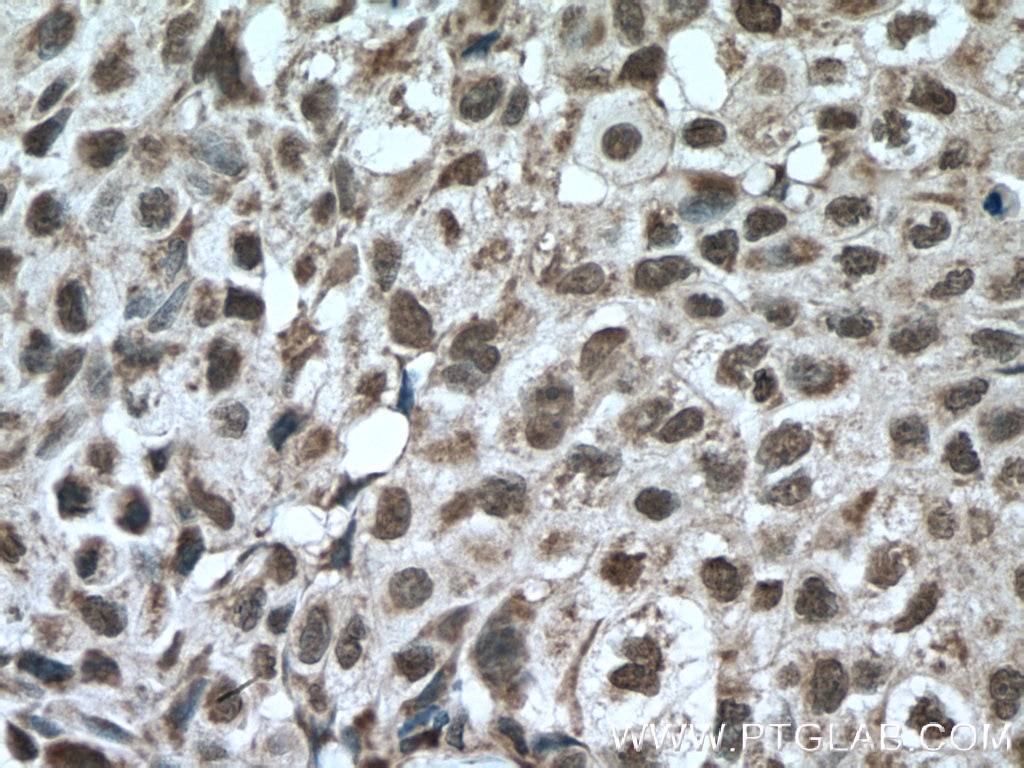 Immunohistochemistry (IHC) staining of human lung cancer tissue using KI67 Polyclonal antibody (27309-1-AP)