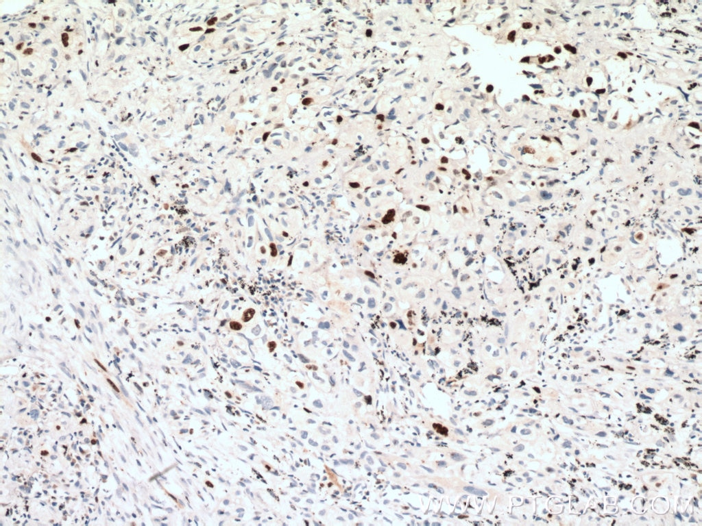 Immunohistochemistry (IHC) staining of human lung cancer tissue using KI67 Polyclonal antibody (27309-1-AP)