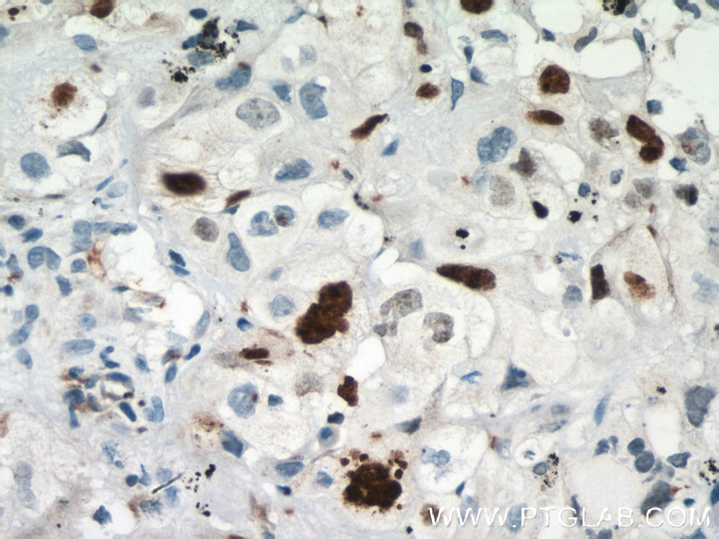 Immunohistochemistry (IHC) staining of human lung cancer tissue using KI67 Polyclonal antibody (27309-1-AP)