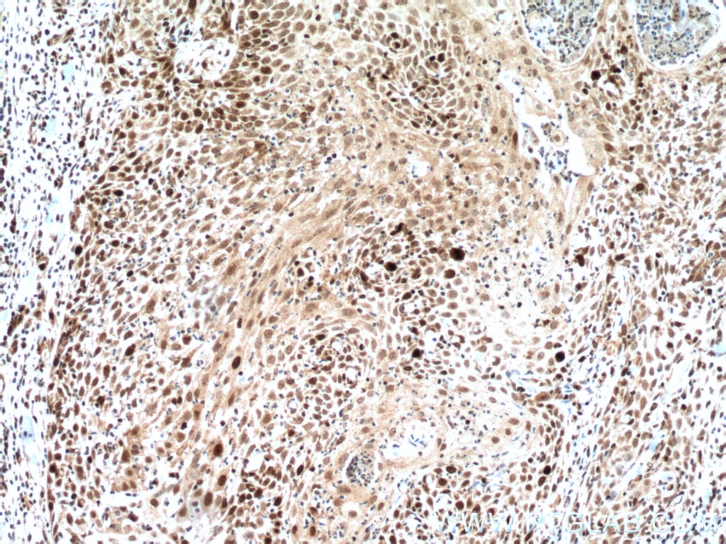 Immunohistochemistry (IHC) staining of human skin cancer tissue using KI67 Polyclonal antibody (27309-1-AP)