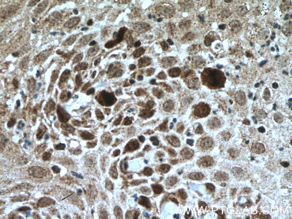 Immunohistochemistry (IHC) staining of human skin cancer tissue using KI67 Polyclonal antibody (27309-1-AP)