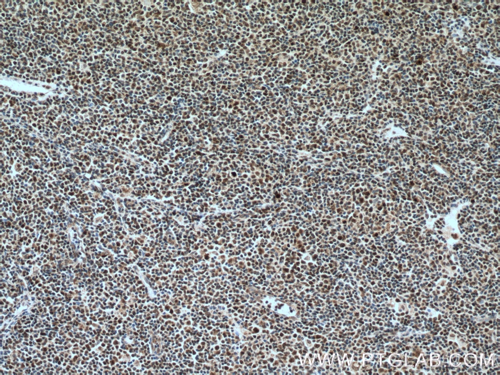 Immunohistochemistry (IHC) staining of human lymphoma tissue using KI67 Polyclonal antibody (27309-1-AP)