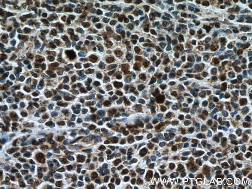 Immunohistochemistry (IHC) staining of human lymphoma tissue using KI67 Polyclonal antibody (27309-1-AP)