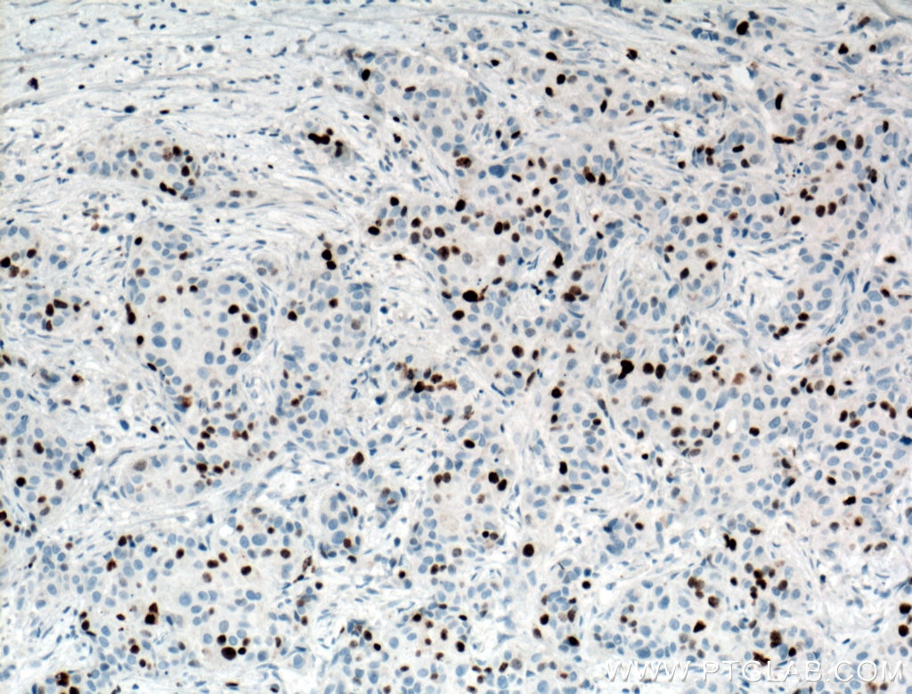 Immunohistochemistry (IHC) staining of human breast cancer tissue using KI67 Polyclonal antibody (27309-1-AP)
