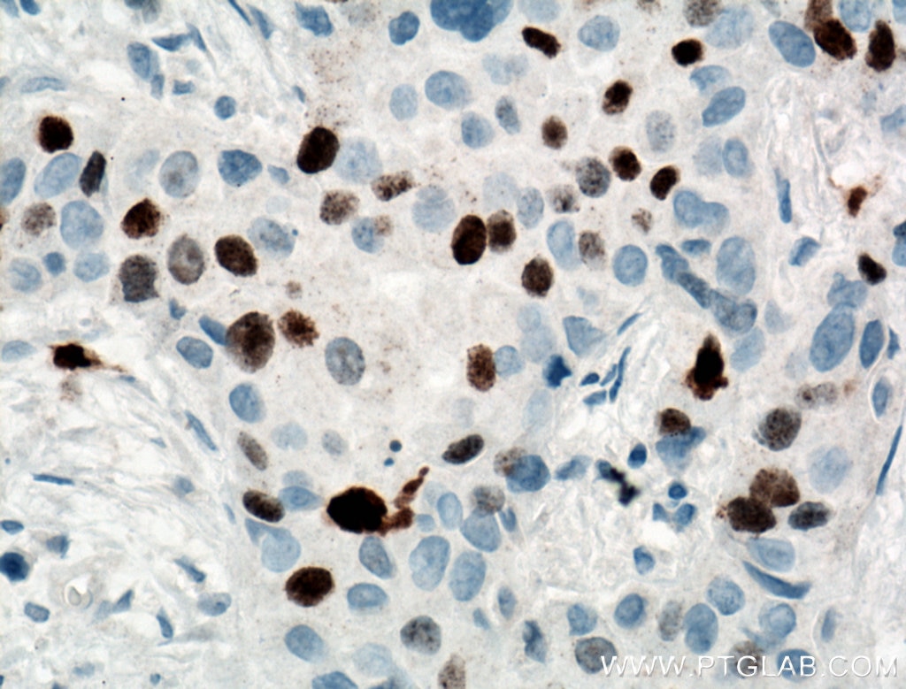 Immunohistochemistry (IHC) staining of human breast cancer tissue using KI67 Polyclonal antibody (27309-1-AP)