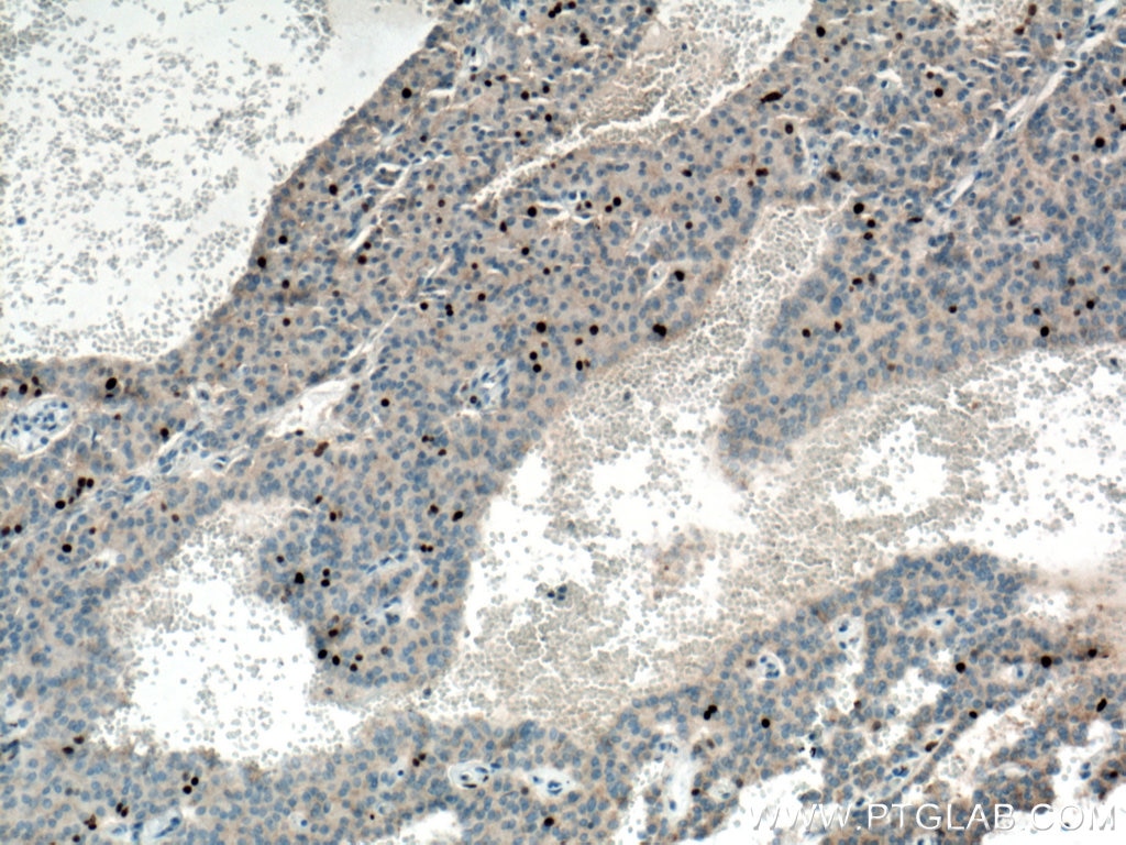 Immunohistochemistry (IHC) staining of Insulinoma tissue using KI67 Polyclonal antibody (27309-1-AP)