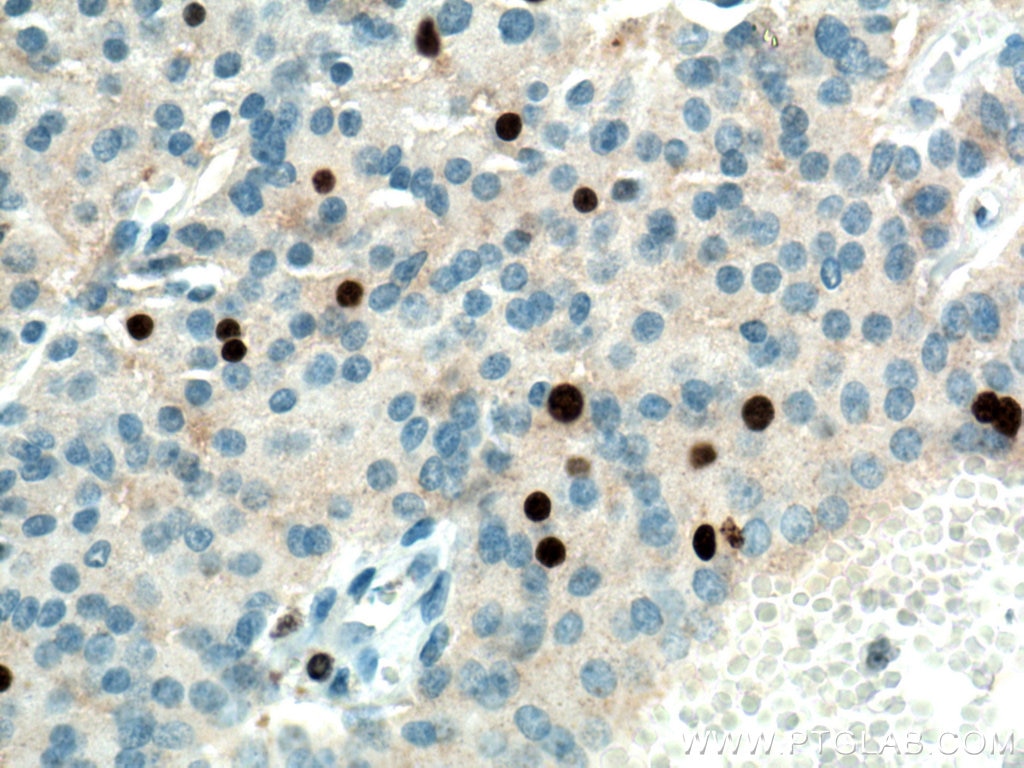 Immunohistochemistry (IHC) staining of Insulinoma tissue using KI67 Polyclonal antibody (27309-1-AP)