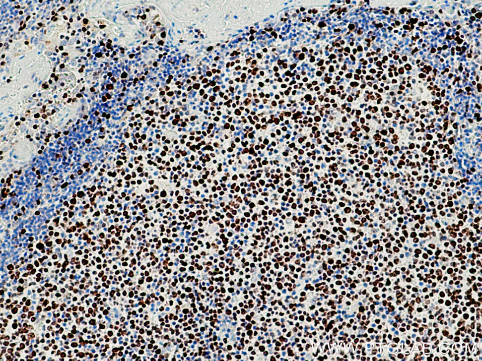 Immunohistochemistry (IHC) staining of human tonsillitis tissue using KI67 Polyclonal antibody (27309-1-AP)