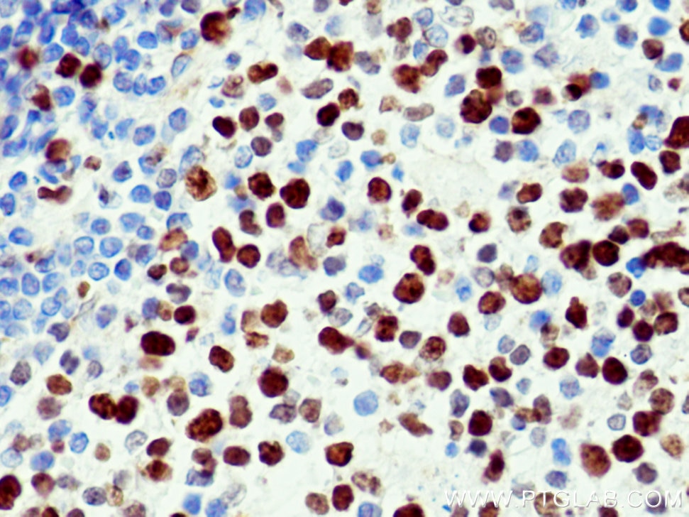 Immunohistochemistry (IHC) staining of human tonsillitis tissue using KI67 Polyclonal antibody (27309-1-AP)