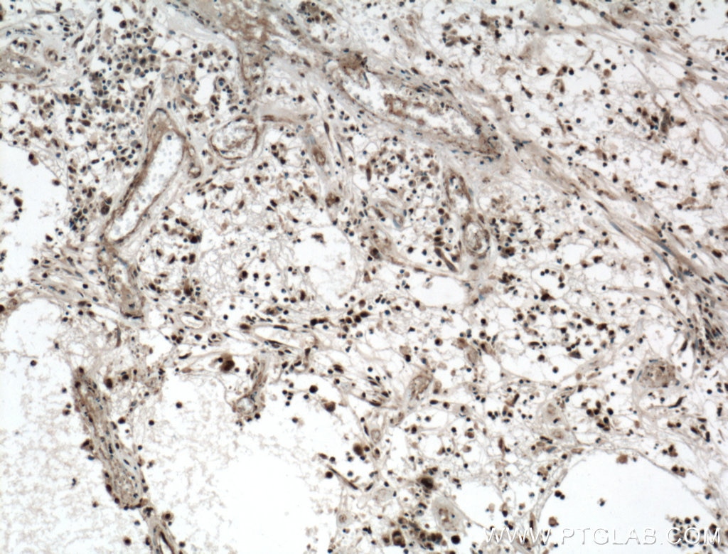 Immunohistochemistry (IHC) staining of human colon cancer tissue using KI67 Polyclonal antibody (27309-1-AP)