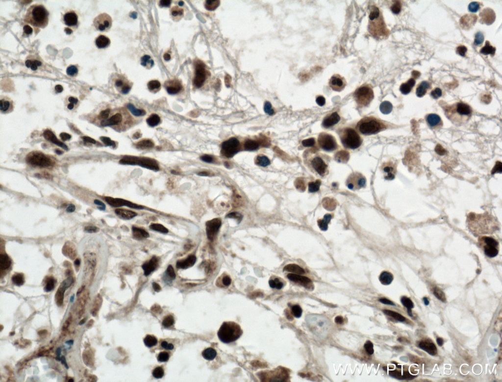 Immunohistochemistry (IHC) staining of human colon cancer tissue using KI67 Polyclonal antibody (27309-1-AP)