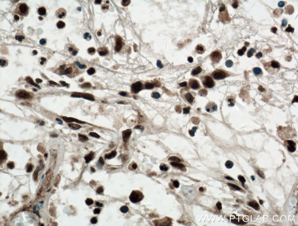 IHC staining of human colon cancer using 27309-1-AP