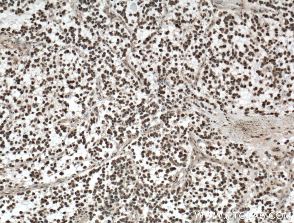 Immunohistochemistry (IHC) staining of human gliomas tissue using KI67 Polyclonal antibody (27309-1-AP)