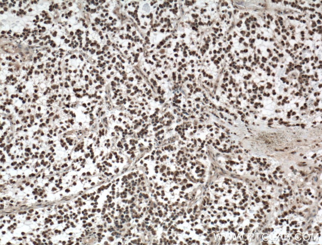 IHC staining of human gliomas using 27309-1-AP