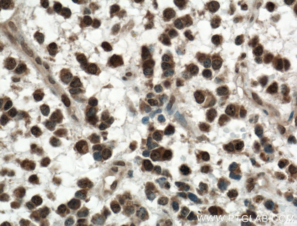 Immunohistochemistry (IHC) staining of human gliomas tissue using KI67 Polyclonal antibody (27309-1-AP)