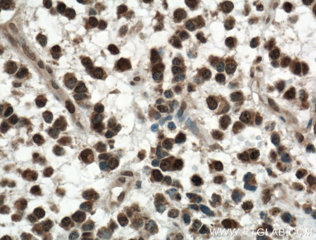 IHC staining of human gliomas using 27309-1-AP