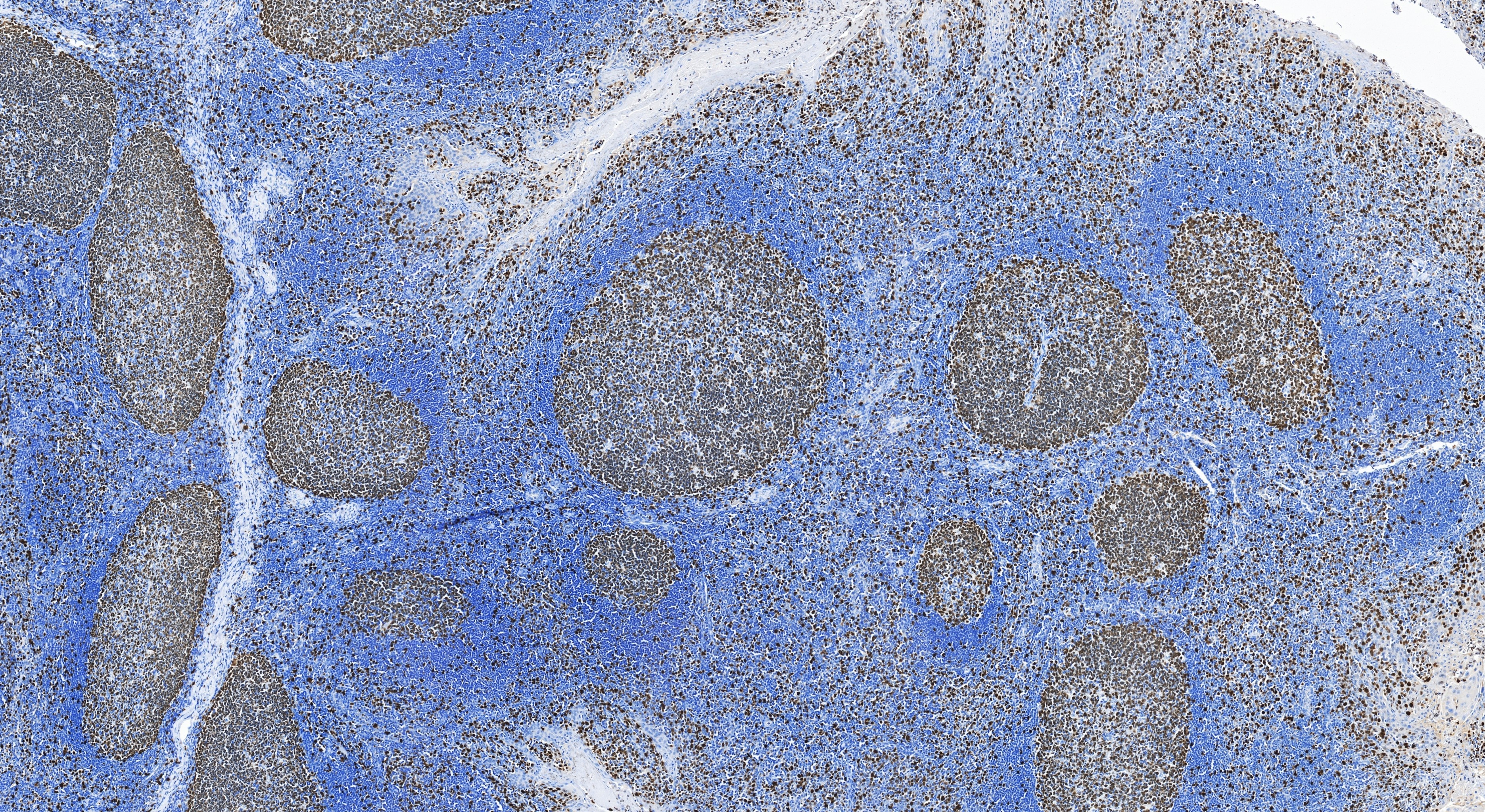 Immunohistochemistry (IHC) staining of human tonsillitis tissue using Ki-67 Recombinant monoclonal antibody (84192-3-RR)