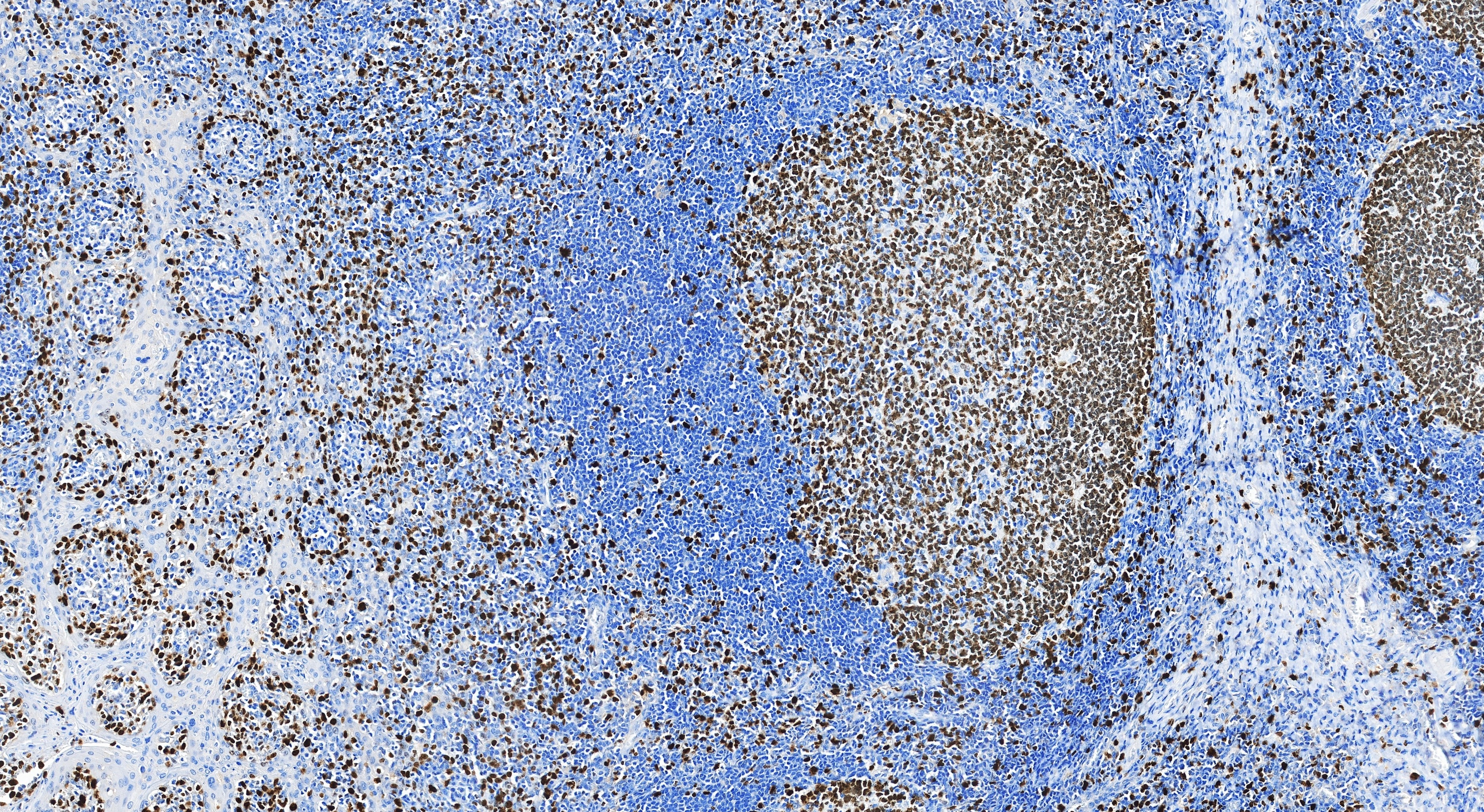 Immunohistochemistry (IHC) staining of human tonsillitis tissue using Ki-67 Recombinant monoclonal antibody (84192-3-RR)