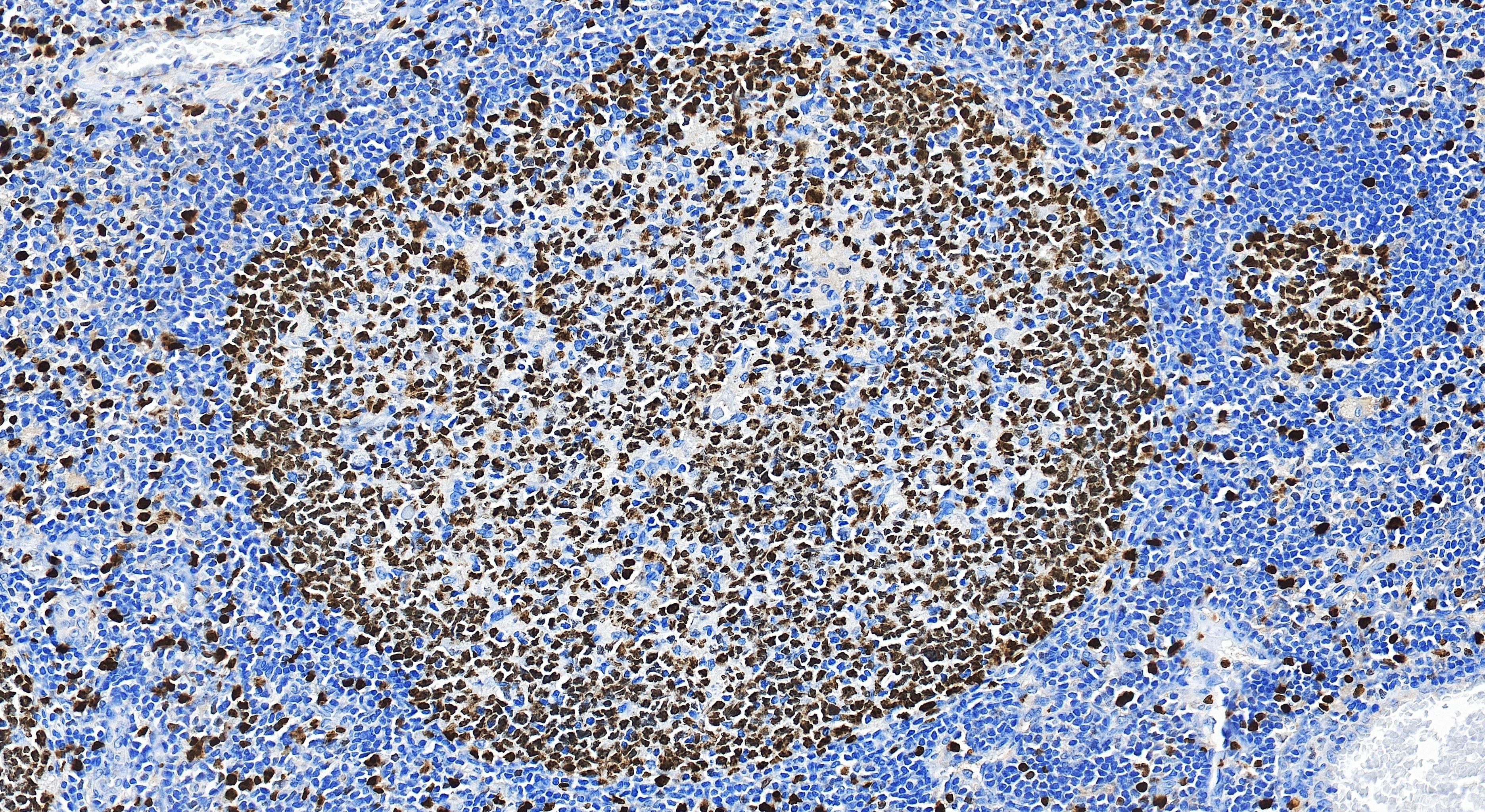 Immunohistochemistry (IHC) staining of human tonsillitis tissue using Ki-67 Recombinant monoclonal antibody (84192-3-RR)