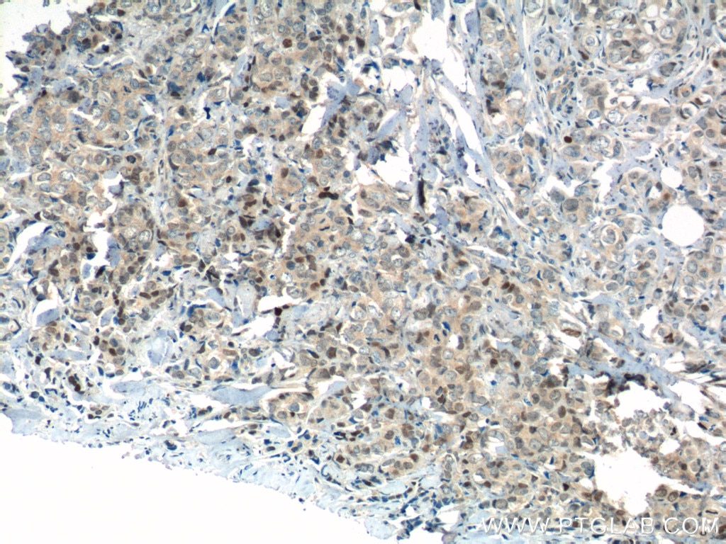 Immunohistochemistry (IHC) staining of human breast cancer tissue using KI67 Polyclonal antibody (19972-1-AP)